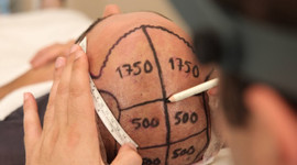 Saç ekimi işlemi ne kadar sürer?