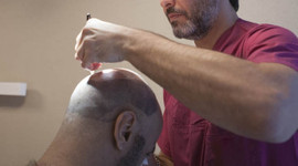 Saç ekim ekonomisi 1 milyar doları geçti